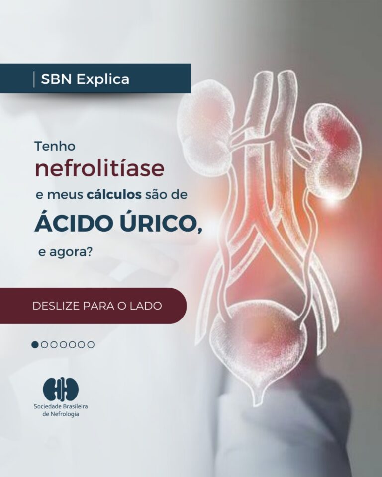 SBN Explica: Como tratar os cálculos de ácido úrico?