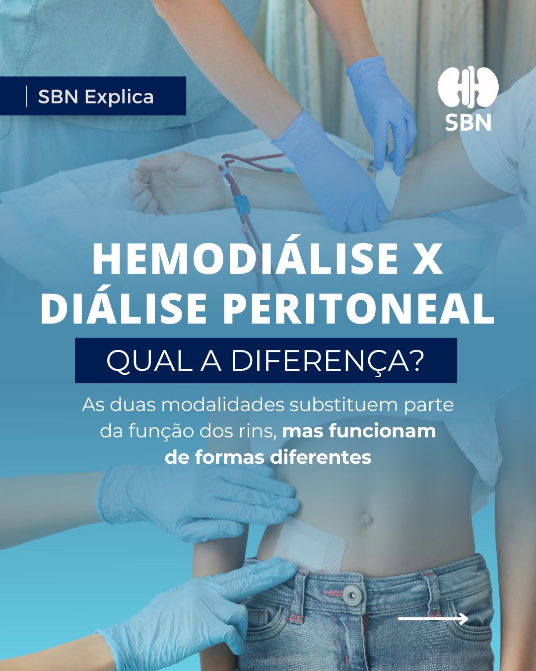 Você sabe qual é a diferença entre a hemodiálise e a diálise peritoneal